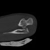 SPORK, NICO - 22.03.1976 - 02.08.2022 - CT obere Extremität - 18:02:23